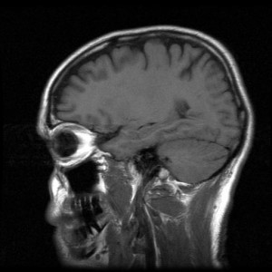 brain scan photo of a brain scan