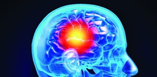 Stroke signs
