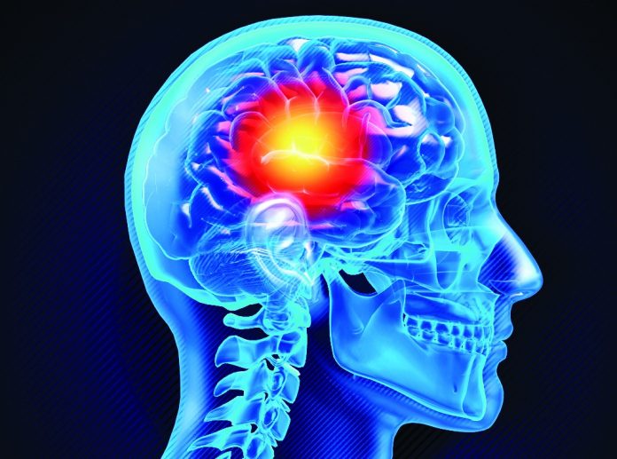 Stroke signs Stroke signs